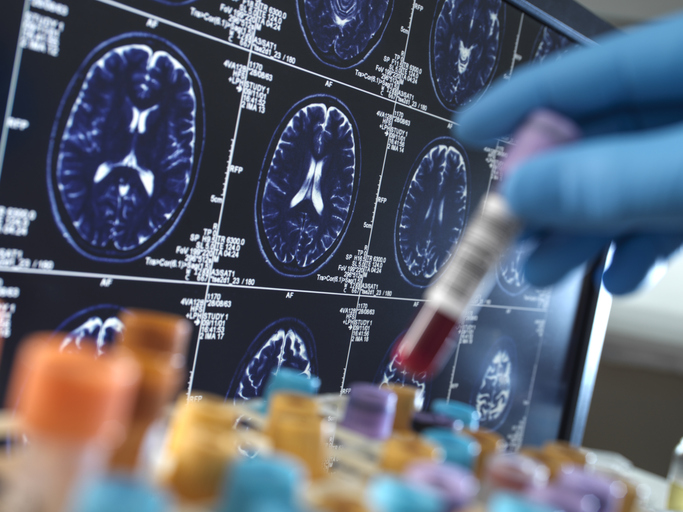 Treat dementia with the same ambition as cancer, says MEP Vautmans