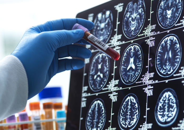 Alzheimer’s can now be caught before symptoms, yet half of cases are still missed