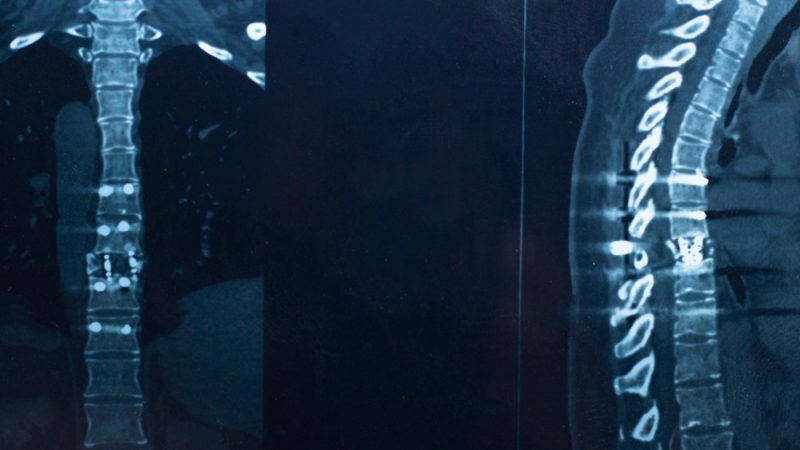 Innovative therapies bring hope for German myeloma patients - Vimarsana News