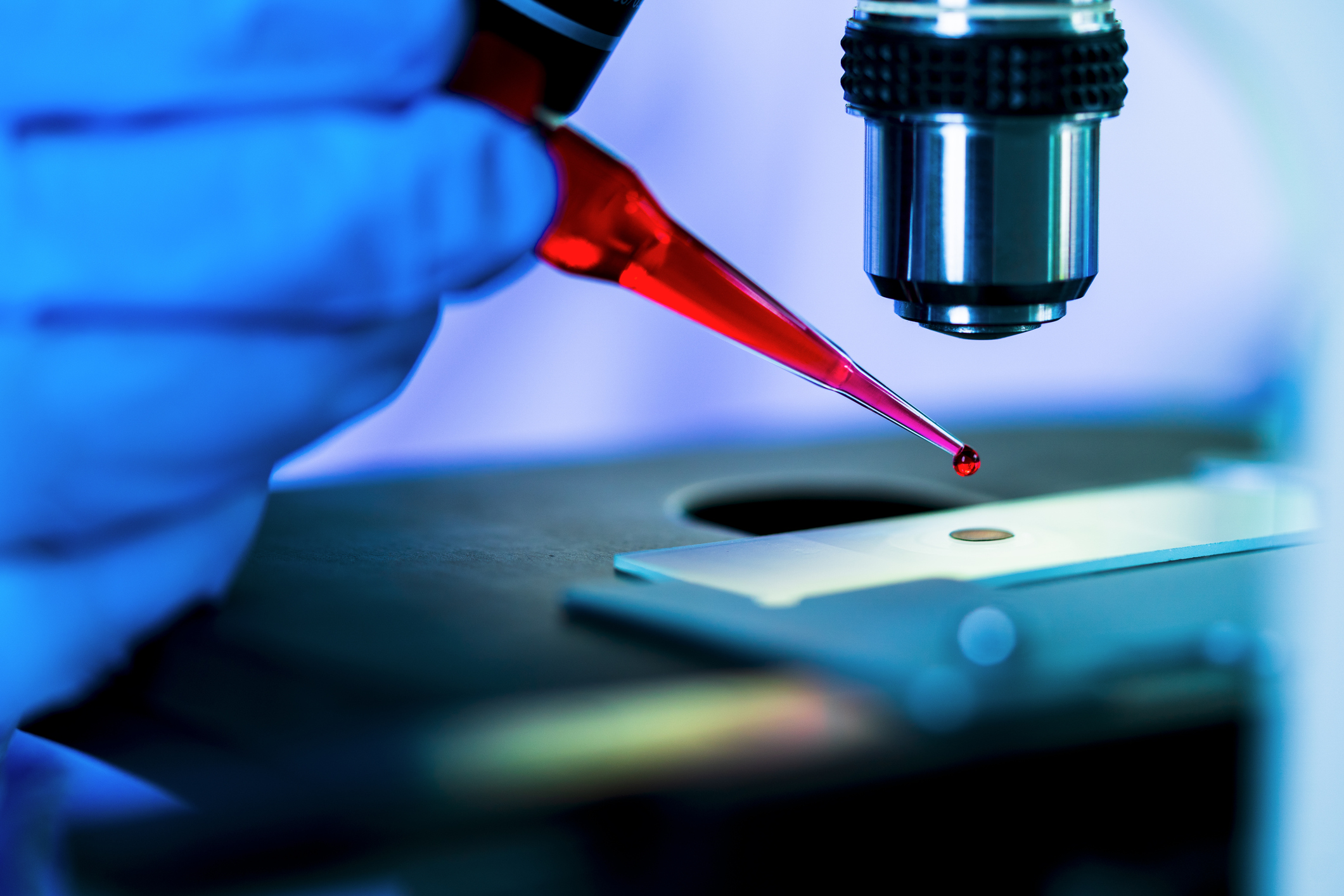 Hungarian Patients Face Long Delays In Multiple Myeloma Diagnosis And Hungarian patients face long delays in multiple myeloma diagnosis and